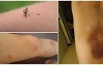Pourquoi subsiste-t-il des ecchymoses après les piqûres de moustiques?