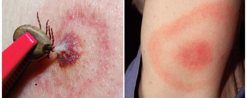 Qu'est-ce que la maladie de Lyme, ses symptômes, son traitement et sa photo