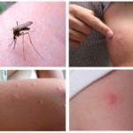 Piqûres de moustiques