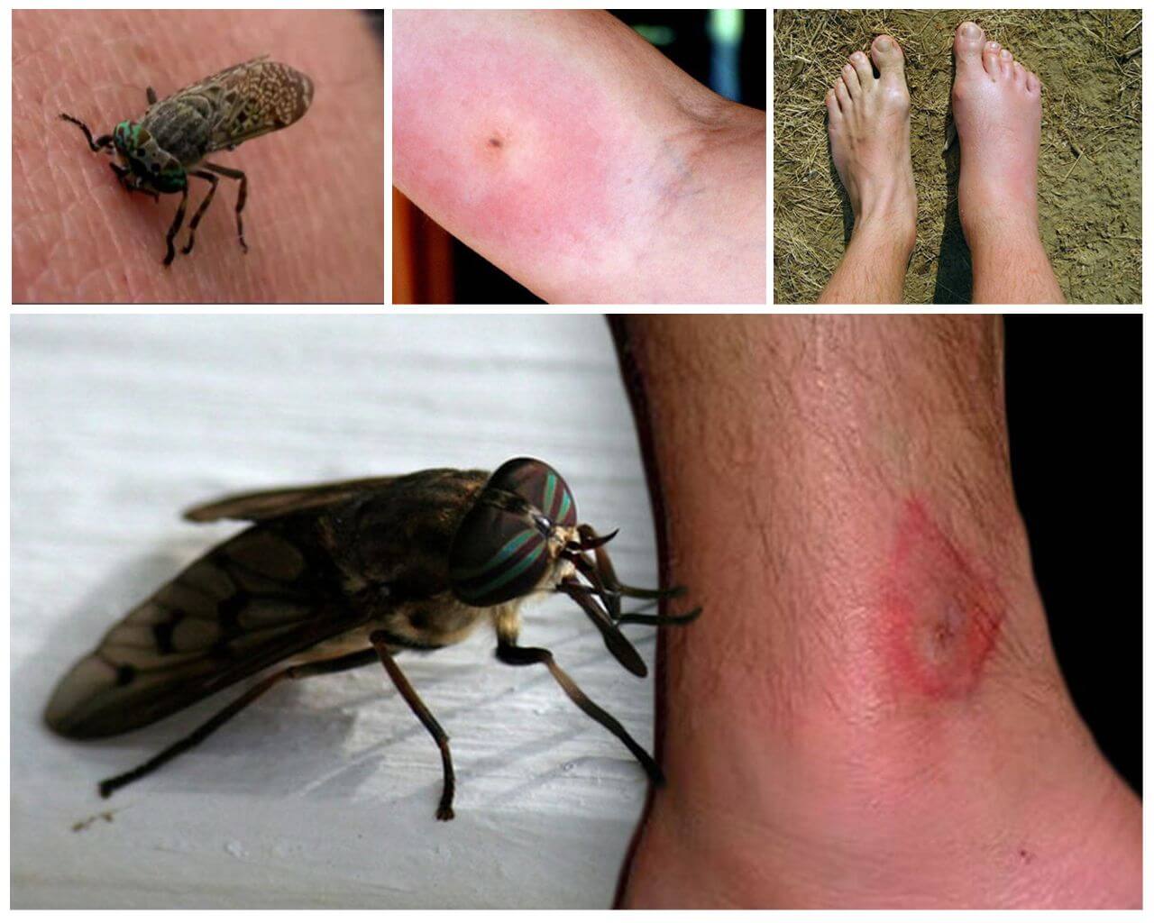 Morsure d'insecte sur le corps humain