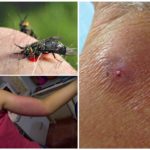 Les effets d'une morsure de mouche