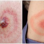 La maladie de Lyme ou la borréliose à tiques